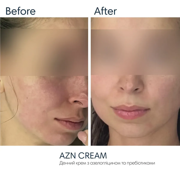 Сонцезахисний крем з протизапальним ефектом Azn Cream SPF 30 Braderm 30 мл 00-00000387 - магазин професійної косметики SELENAVI