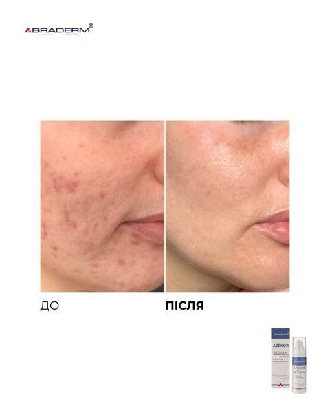 Крем для комплексного контролю акне та підтримки ремісії Azekur Cream Braderm 30 мл
