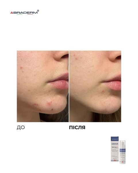 Крем для комплексного контролю акне та підтримки ремісії Azekur Cream Braderm 30 мл