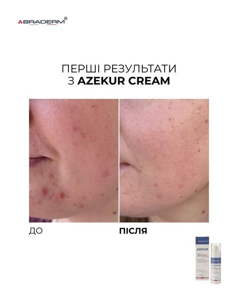 Крем для комплексного контролю акне та підтримки ремісії Azekur Cream Braderm 30 мл