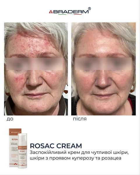 Заспокійливий крем з азелаїновою кислотою Rosac Cream Braderm 30 мл 111 - магазин професійної косметики SELENAVI
