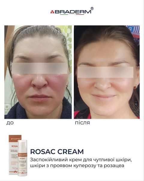 Заспокійливий крем з азелаїновою кислотою Rosac Cream Braderm 30 мл 111 - магазин професійної косметики SELENAVI