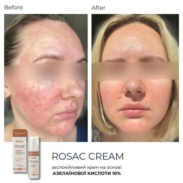 Заспокійливий крем з азелаїновою кислотою Rosac Cream Braderm 30 мл 111 - магазин професійної косметики SELENAVI